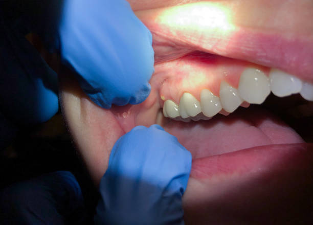 Best Emergency Root Canal Treatment in Berkley, MI